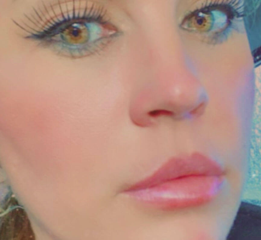 Restylane for fuller, shapelier lips.​