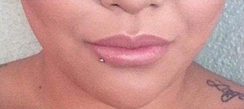 Before and After – Restylane​