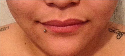 Before and After – Restylane​