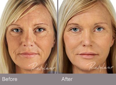 Before and After – Restylane​