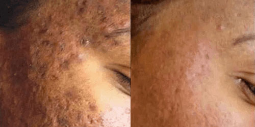 Before and After: Microneedling​
