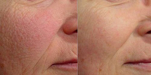 Before and After: Microneedling​