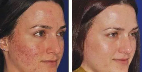 Before and After: Microneedling​