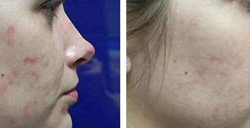 Before and After: Microneedling​