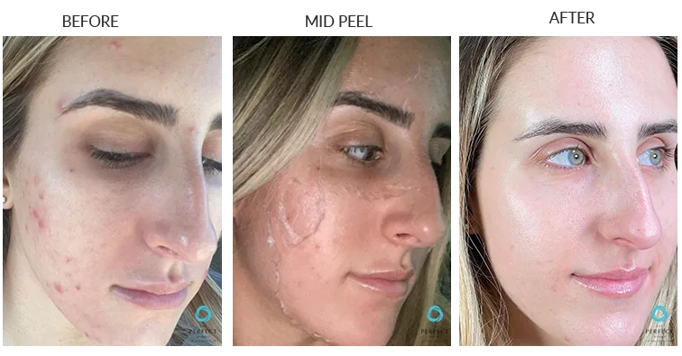 Peel Results - Before & After