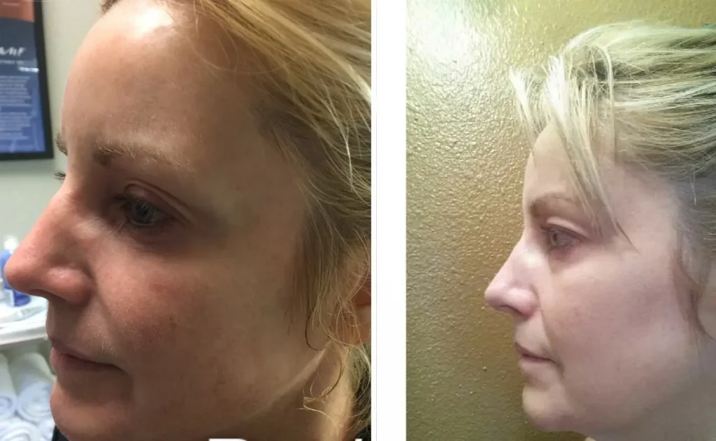 Microneedling pre-and-post - actual patient
